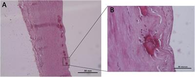 ETS-Related Gene Expression in Healthy Femoral Arteries With Focal Calcifications